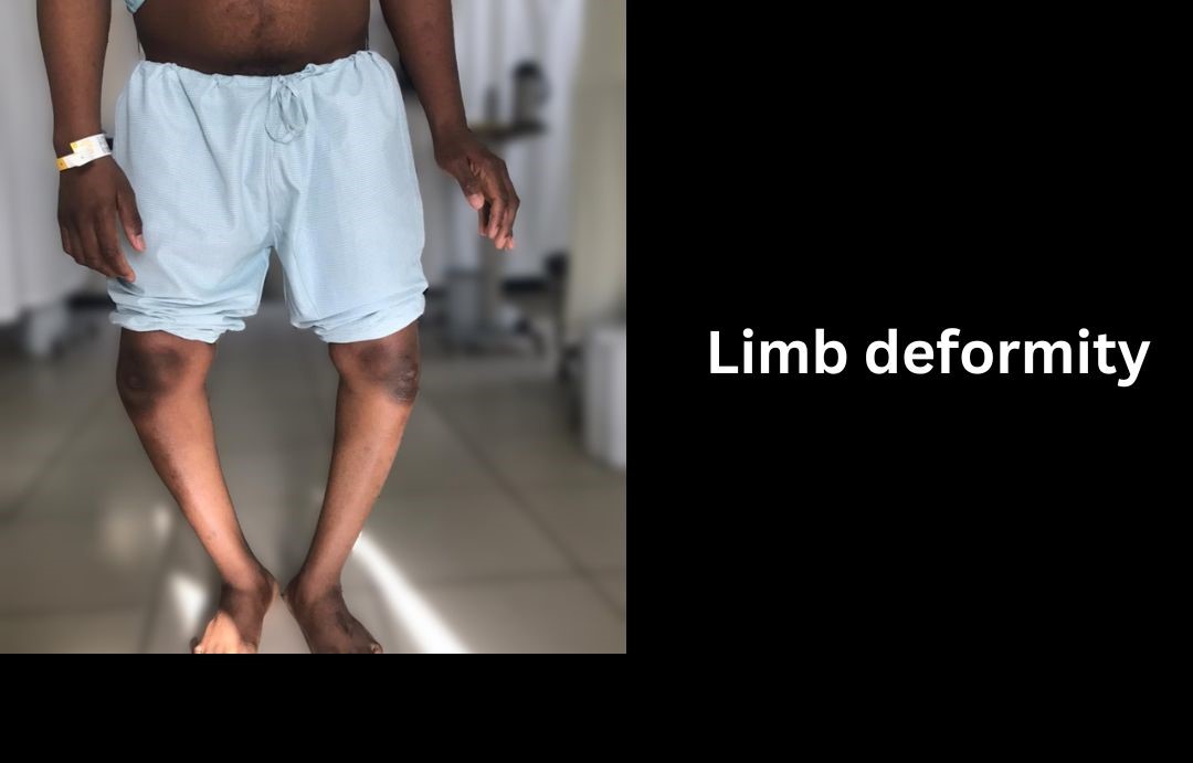 Limb Deformity Correction in Delhi